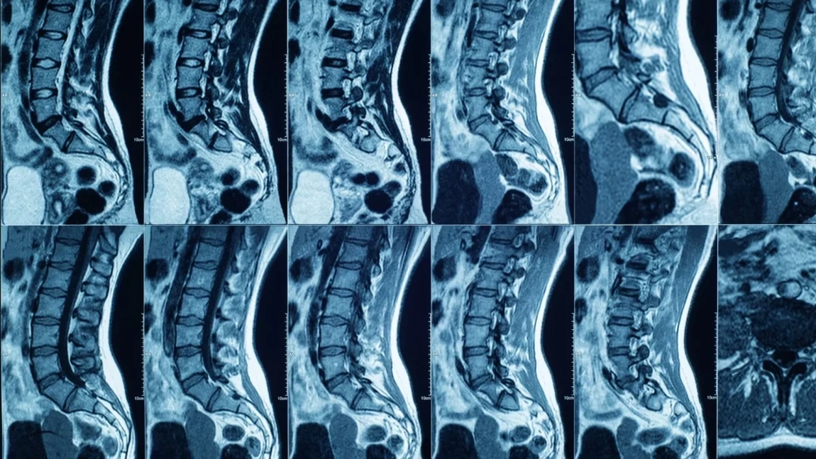 Ce preț are un RMN la coloana lombară? Află ce implică investigația, dar și de ce este necesară!