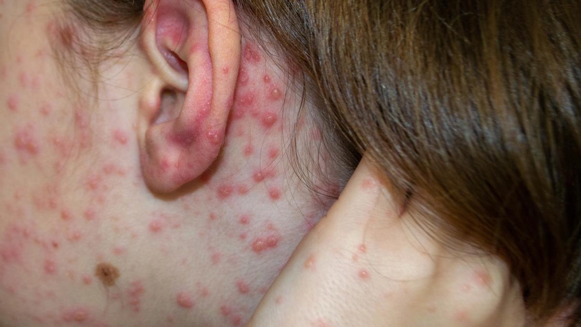 Ce este semnul Koplik? Dr. Oana Cuzino explică ce boală anunță!