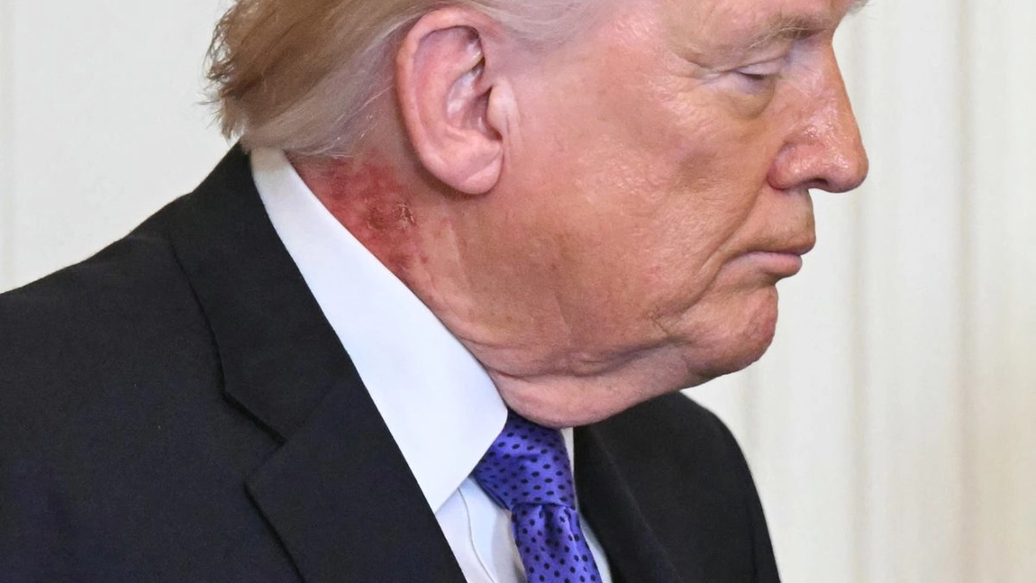 Speculații medicale după apariția lui Donald Trump. Ce ascunde pata roșie de pe gât