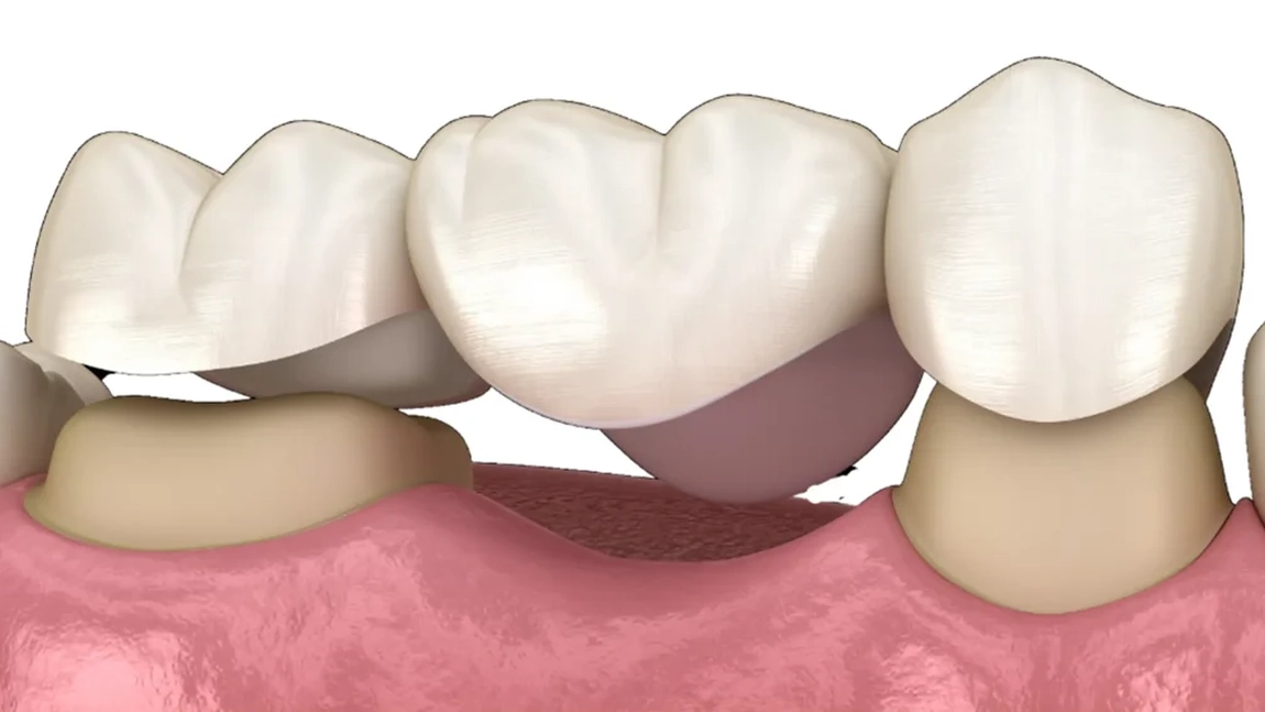 Ce preț are o punte dentară de 3 dinți? Iată care sunt factorii care determină costul!
