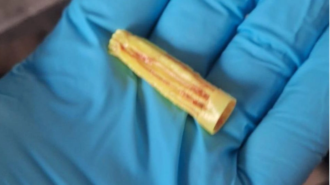 Copil din Botoșani salvat în ultima clipă după ce s-a asfixiat cu un obiect din plastic!