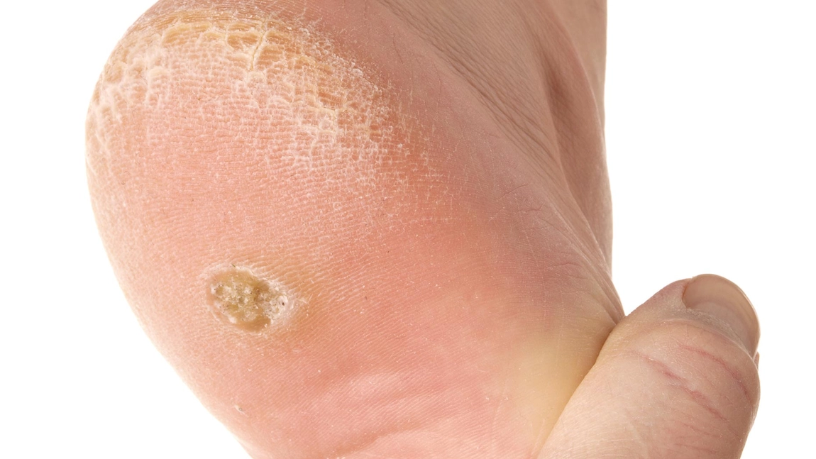 Verucile plantare: remediul simplu al bunicii