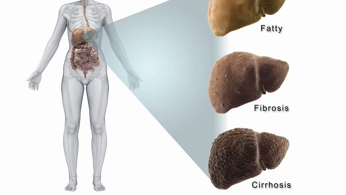 Cum stii ca ai fibroza hepatica. Simptome si stadii