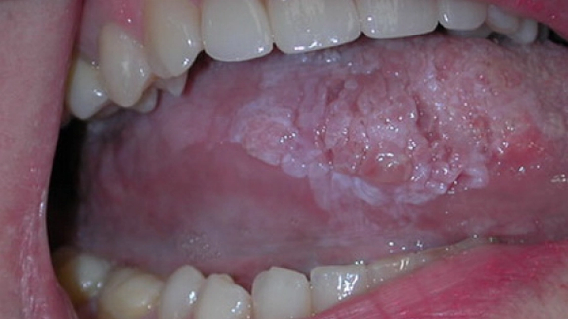 5 semne care tradeaza cancerul de limba