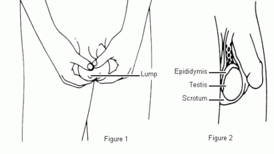 Controlul testiculelor. De ce este importanta autoexaminarea testiculelor si cand trebuie facuta