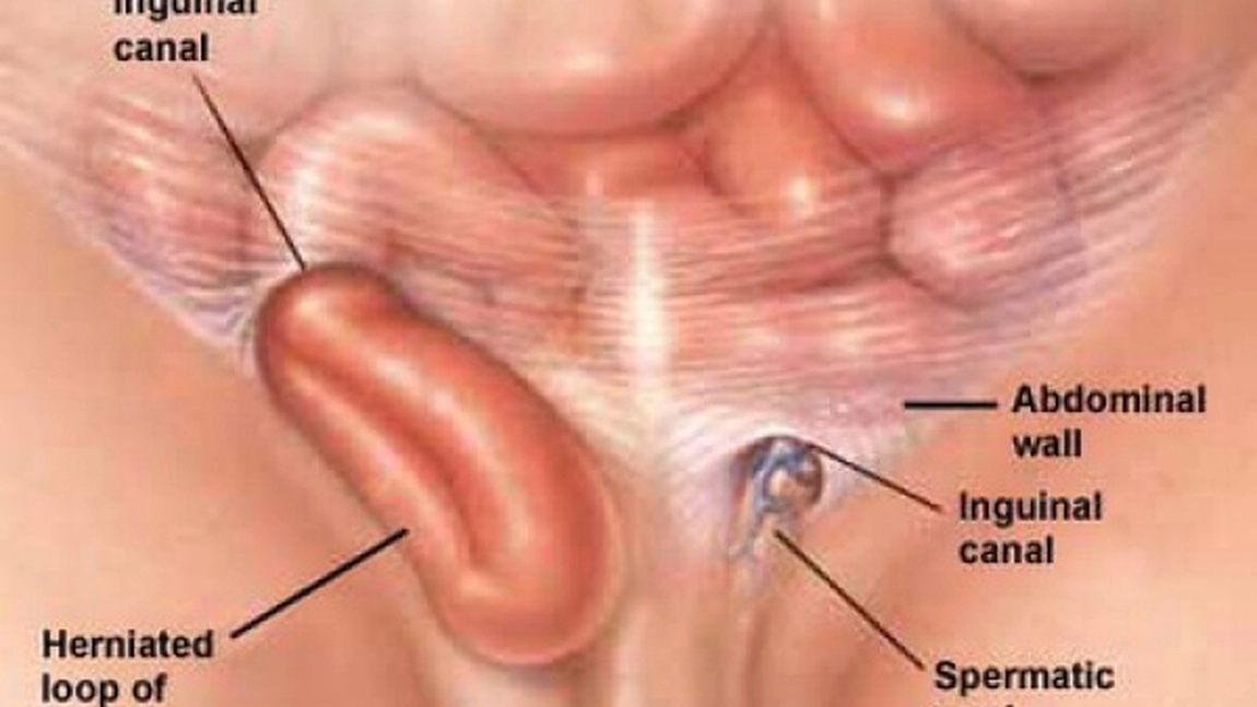 Hernia inghinala. Cauze si simptome