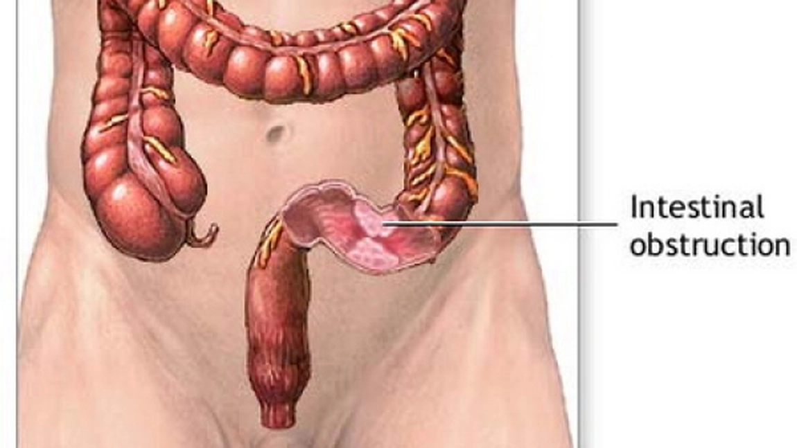 Ocluzia intestinala. Simptome si cauze