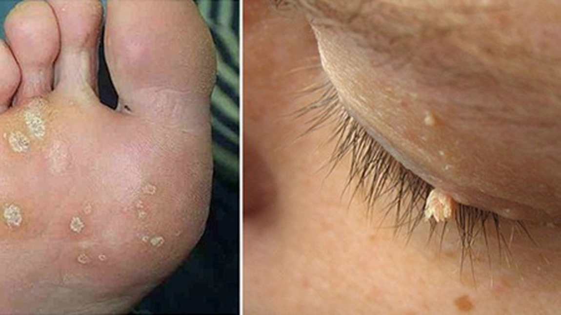 Ce sunt negii, cum se transmit si in ce caz pot duce la cancer