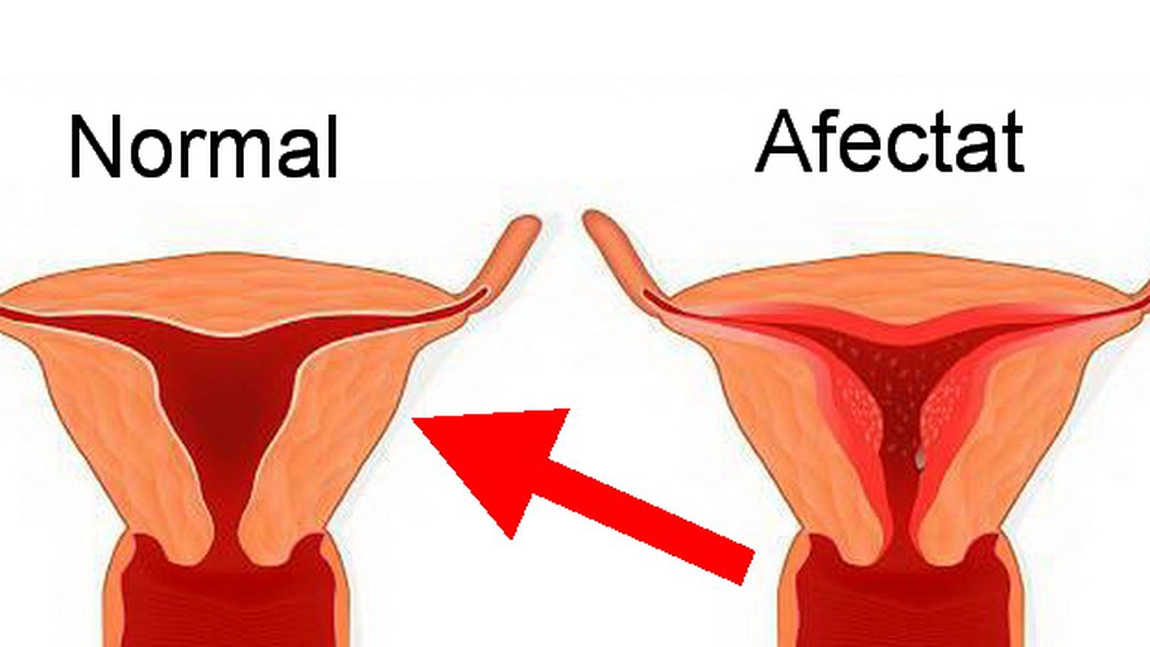 Menstruatia abundenta: cauze si tratament
