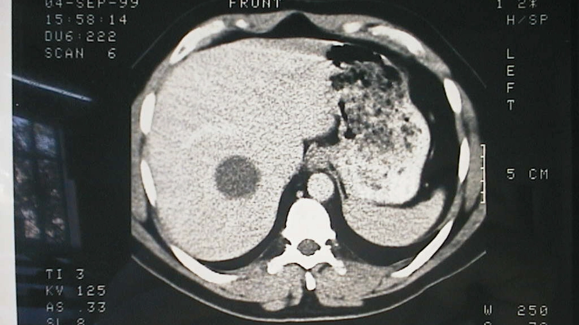 Ce trebuie sa stim despre chistul hepatic