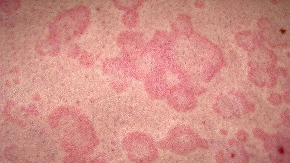 Sfatul dermatologului: Simptomele bubelor dulci si cum le tratam