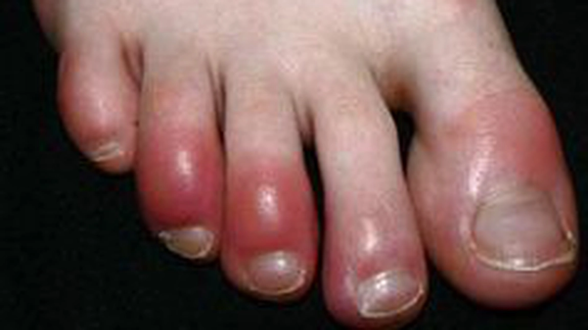 Degeraturile: simptome, preventie, prim ajutor, complicatii