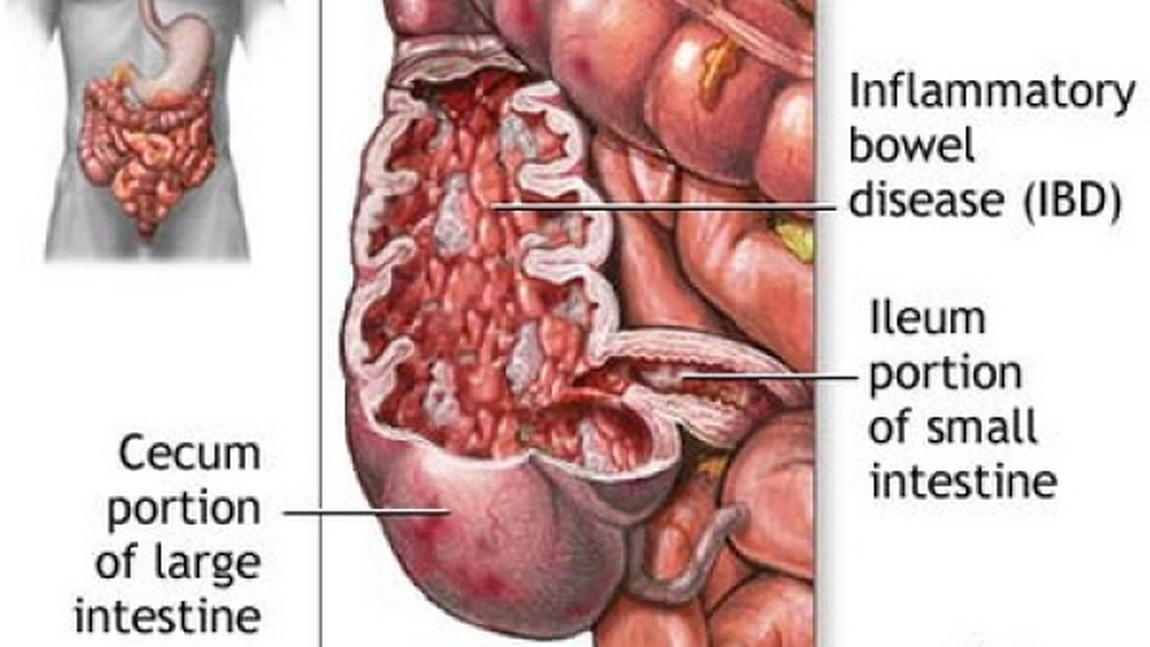 Rectocolita ulcero-hemoragica. Simptome, diagnostic si tratament