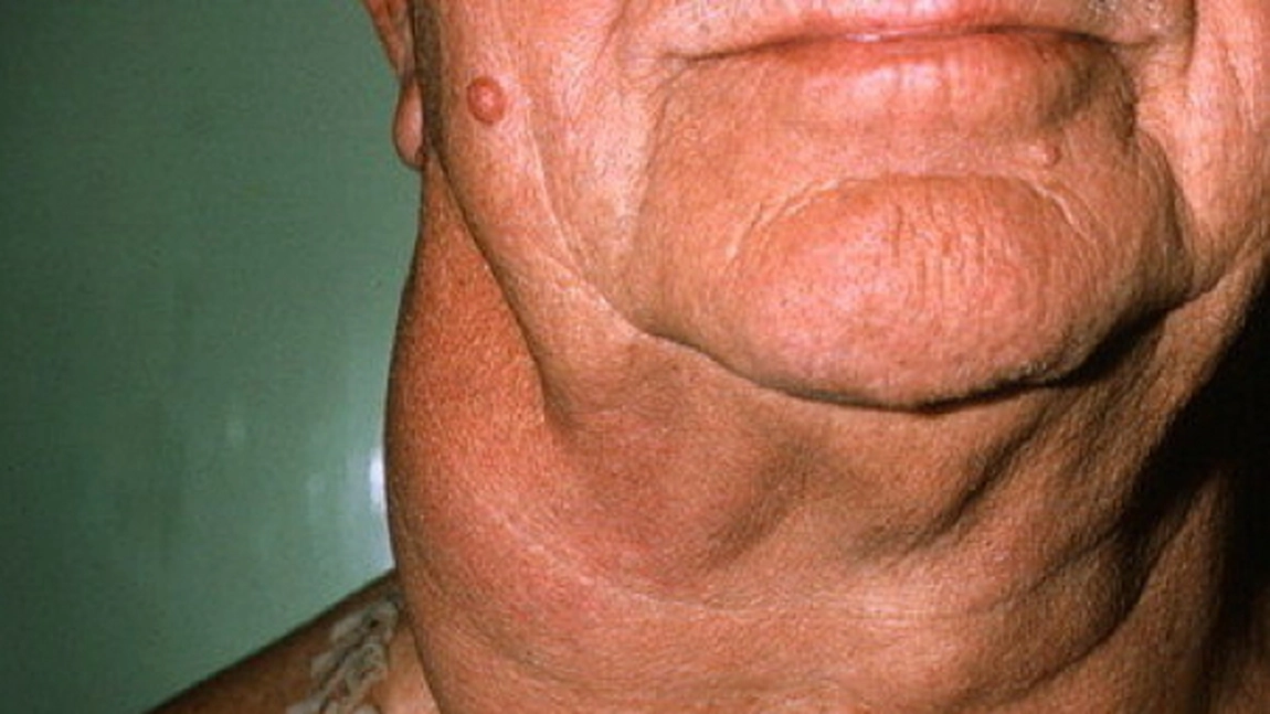 Limfomul non-Hodgkin. Cauze si simptome