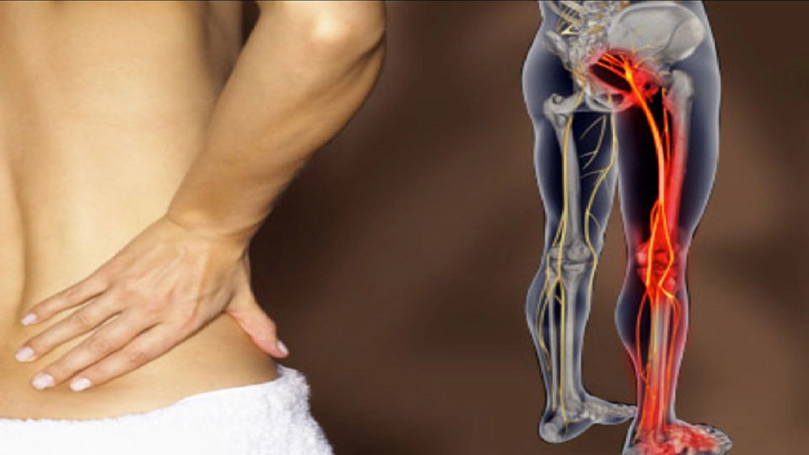 Cel mai eficient antiinflamator natural pentru sciatica. Vezi cum il poti folosi