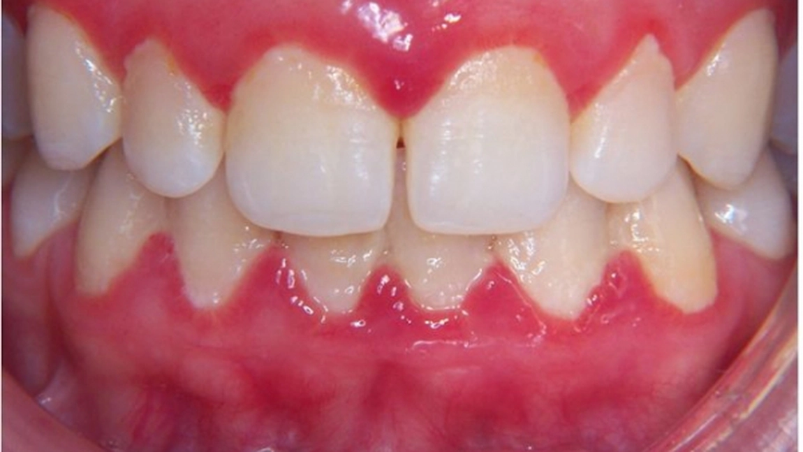 Cum se formeaza placa bacteriana