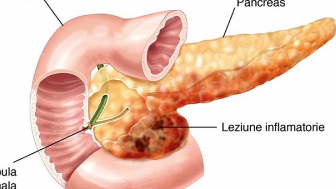 Cum tratezi naturist pancreatita