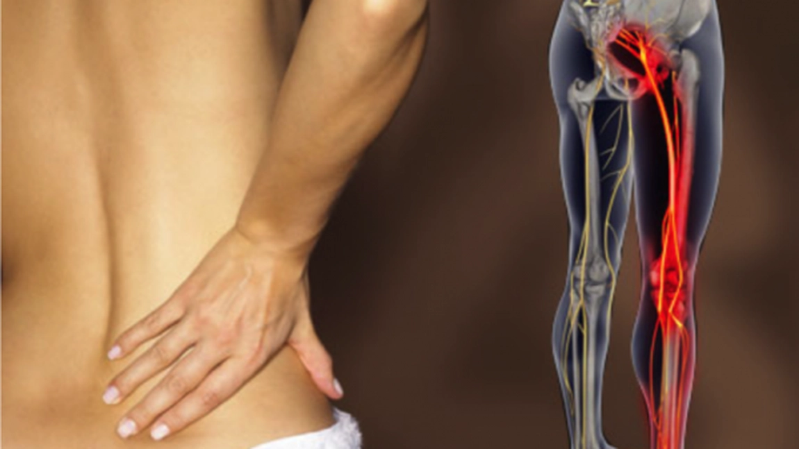 Criza de sciatica. Cum o tratam