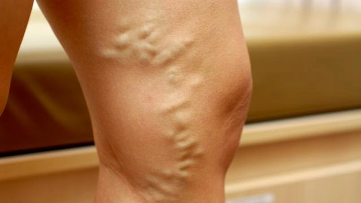 Reteta cu otet de mere pentru tratamentul varicelor
