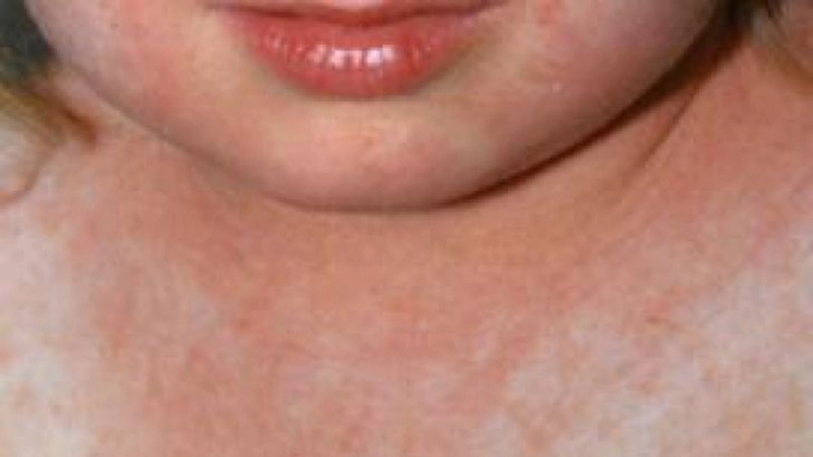 Bolile copiilor: Scarlatina. Cauze, simptome, tratament, complicatii