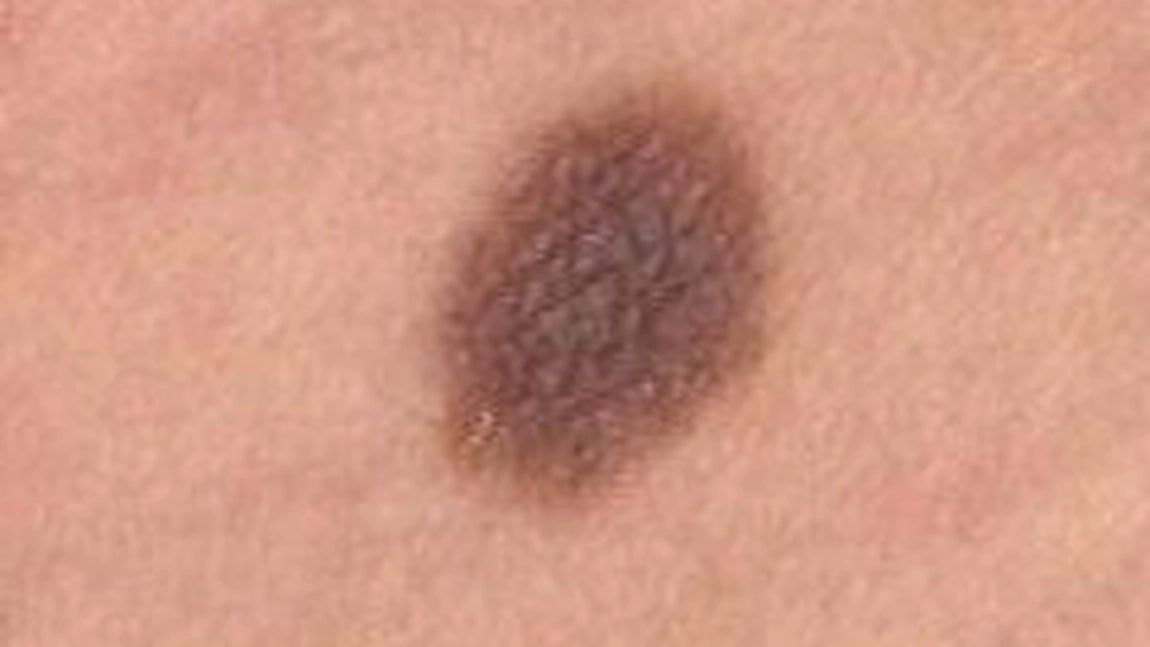 Indicii ca suferi de cancer de piele. Iata tipurile de cancer de piele