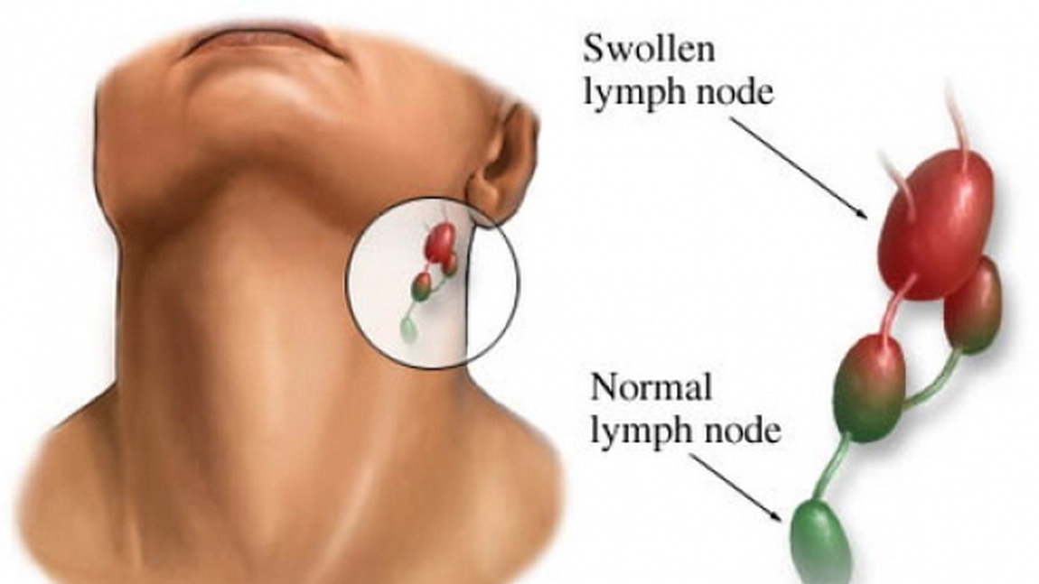 Acesta este un remediu 100% natural foarte bun pentru tratarea ganglionilor limfatici!
