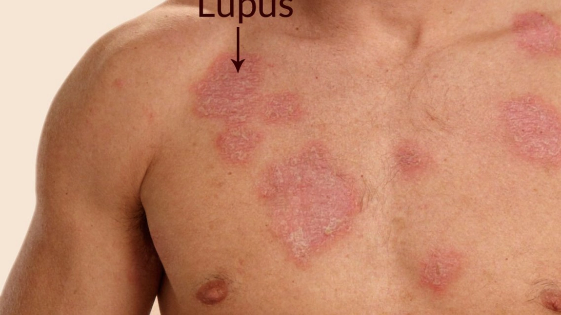 Ce trebuie sa stim toti despre lupus