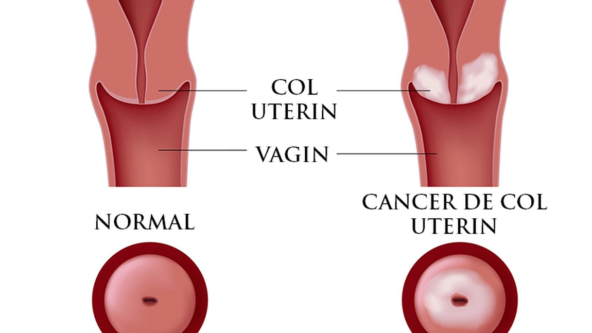 Tratament naturist eficient pentru rana pe colul uterin: vindecarea este spontana, fara recidiva
