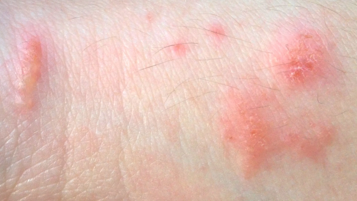 Ce este dermatita iritativa de contact