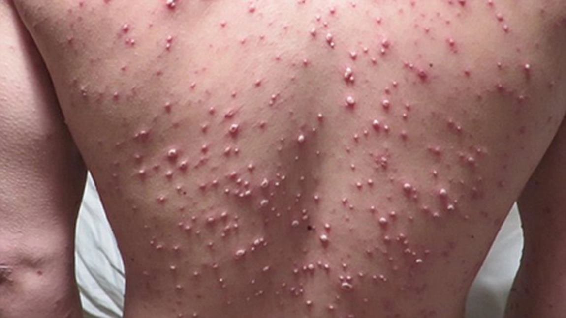 Atentie! Epidemie de varsat de vant!