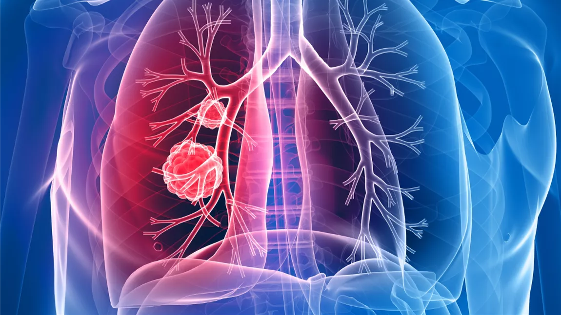 Toată lumea ar trebui să cunoască acest simptom clar al cancerului pulmonar