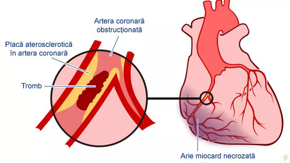Infarct miocardic simptome. Ce spun cardiologii - VIDEO