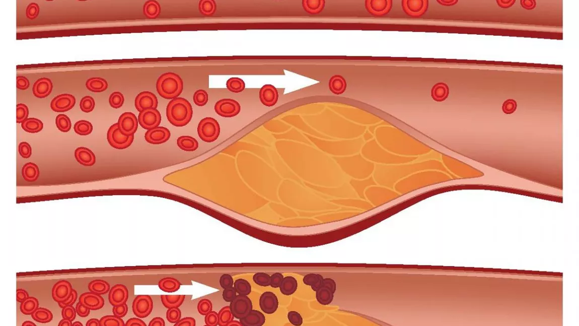 Placa de aterom: cauze, cum se formează și cum se tratează?