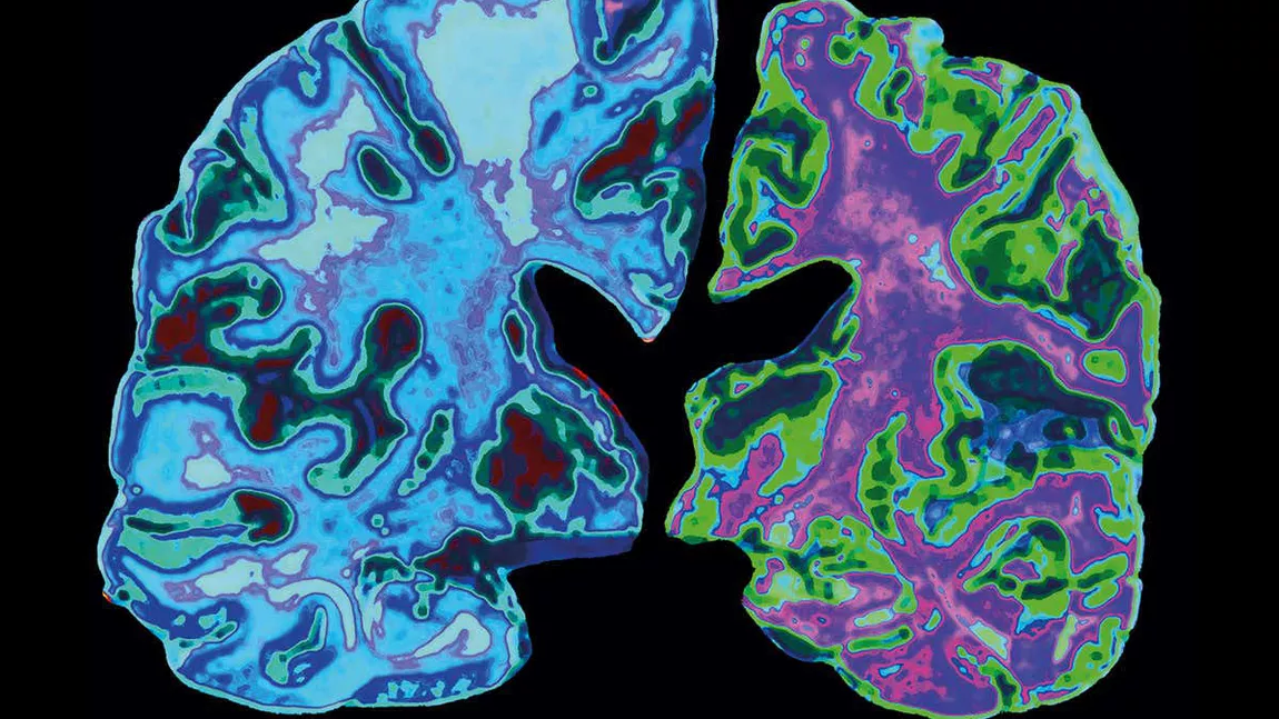 Alzheimer: ce se întâmplă de fapt în creier