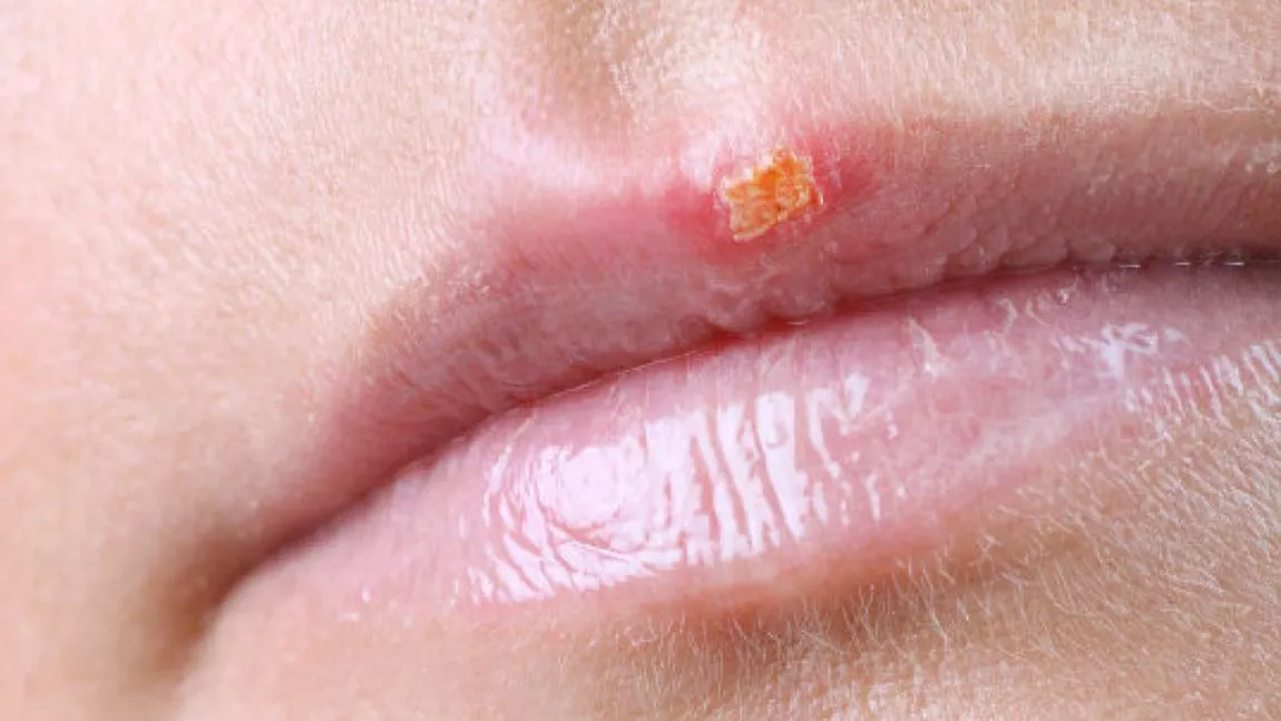 Herpes: a fost descoperit un nou tratament care ar distruge complet virusul