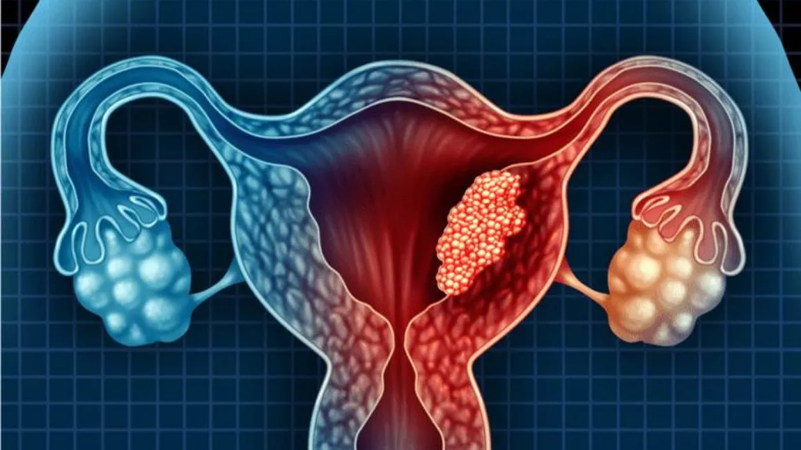 3 simptome de avertizare ale cancerului de col uterin