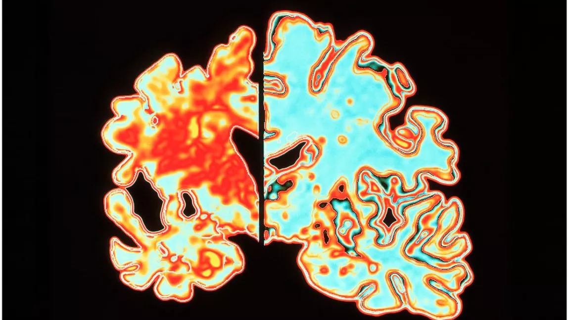 Noi cercetări arată că există, de fapt, trei subtipuri diferite ale maladiei Alzheimer