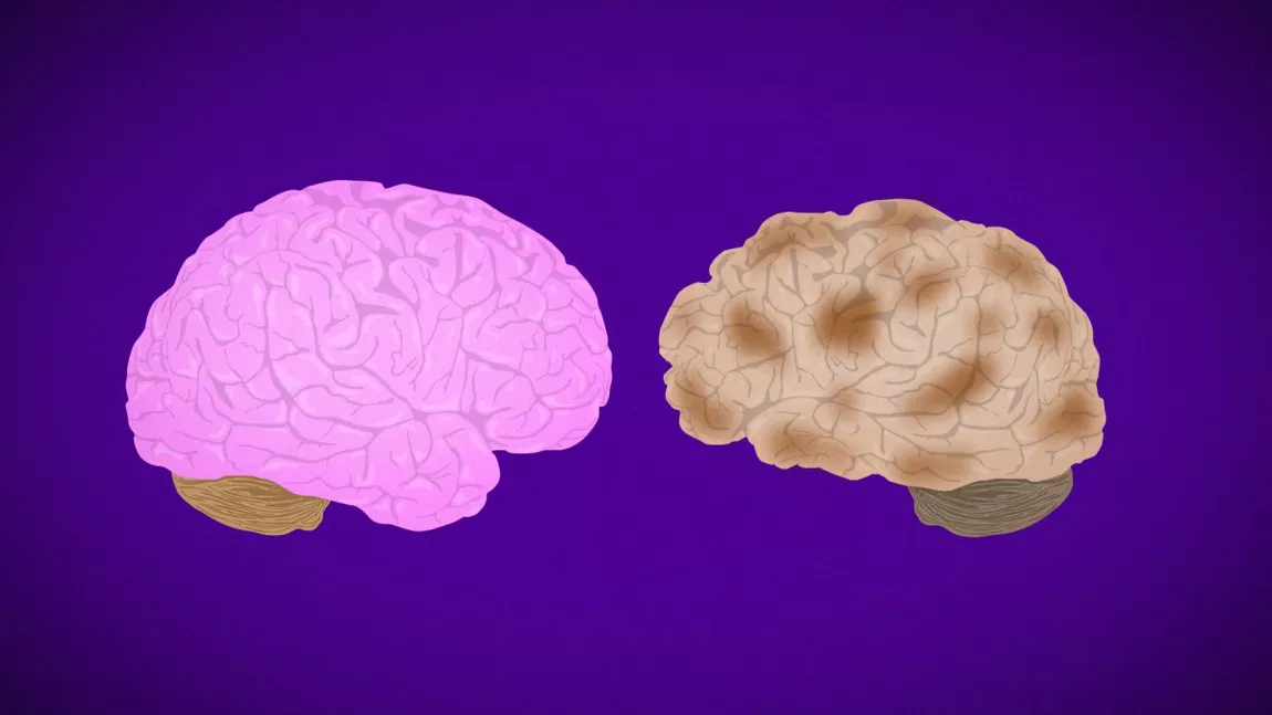 Boala Alzheimer: canabisul ar putea îmbunătăți abilitățile cognitive