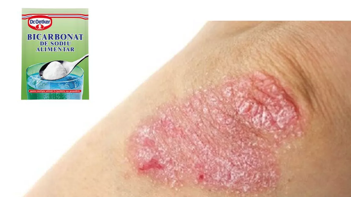 Bicarbonat pentru eczeme: Cum să scapi ușor de dermatită