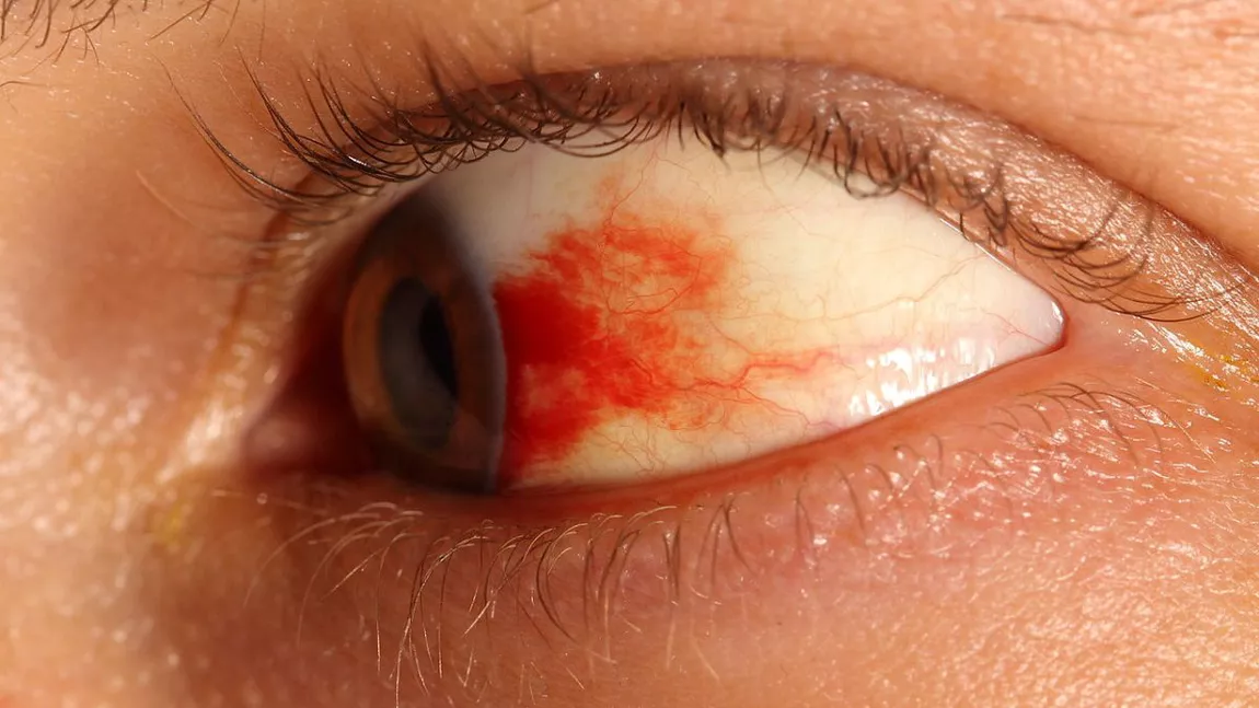 De ce se sparg vasele de sânge la ochi: Află care sunt cauzele hemoragiei subconjunctivale și când ar trebui să mergi la medic