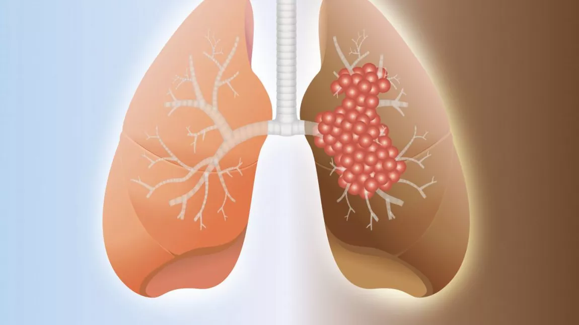 „M-am vindecat de fibroza pulmonară”: Un vis mare