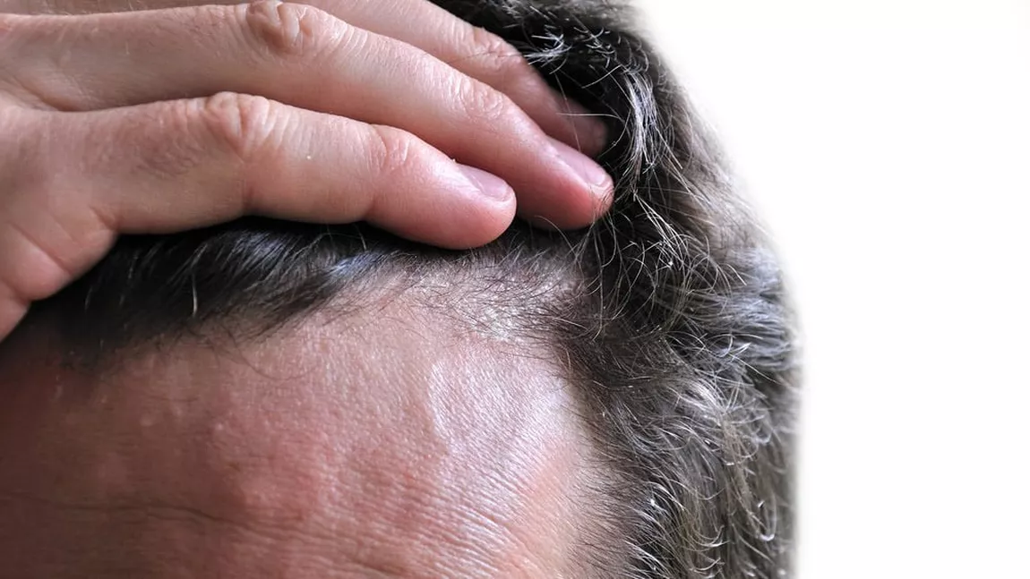 Ciuperca scalpului tratament: Prevenirea afecțiunii și ameliorarea primelor simptome