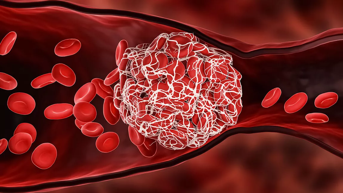Ce afecțiune anunță apariția unui cheag de sânge la plămâni? Cauze, simptome și tratament