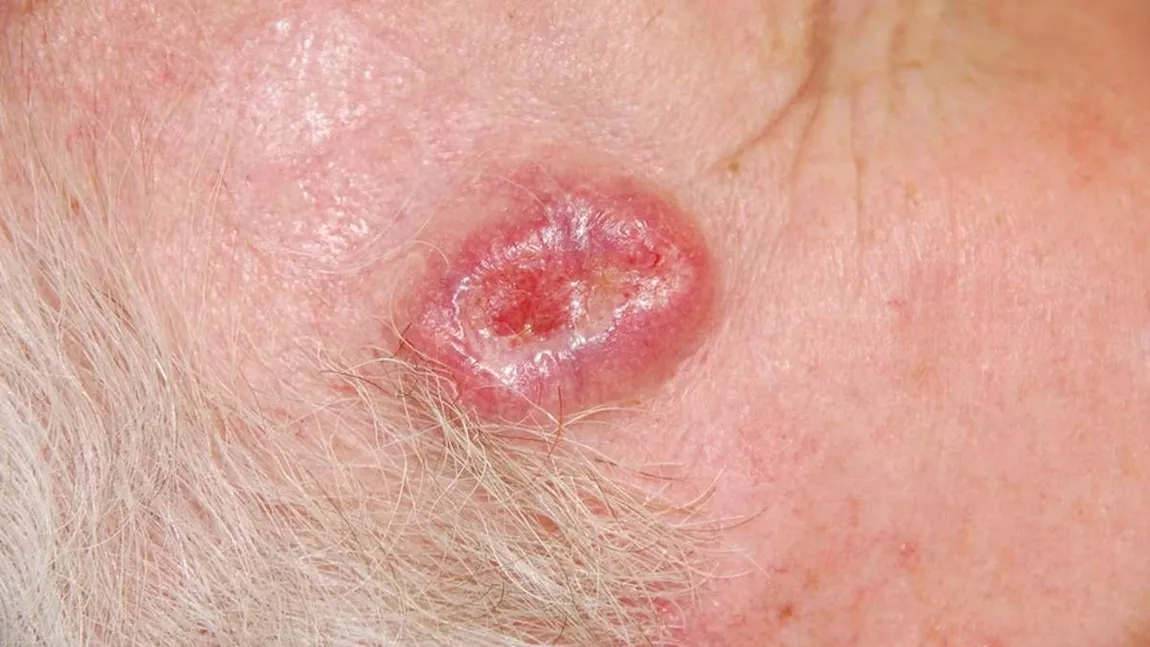 Cancer de piele imagini. De ce se dezvoltă melanomul?