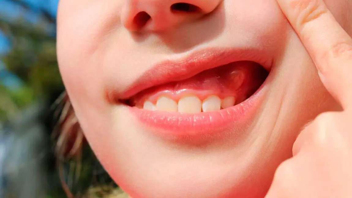 Abcesul dentar se sparge singur. Cum să intervii imediat pentru a calma durerea folosind remedii naturiste