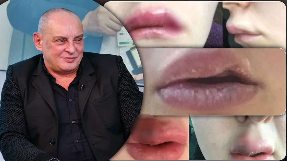 Refuzate de medici, adolescentele care își doresc operații estetice se adresează cosmeticienilor! Rezultatul nu este mereu unul fericit, multe ajungând să fie mutilate