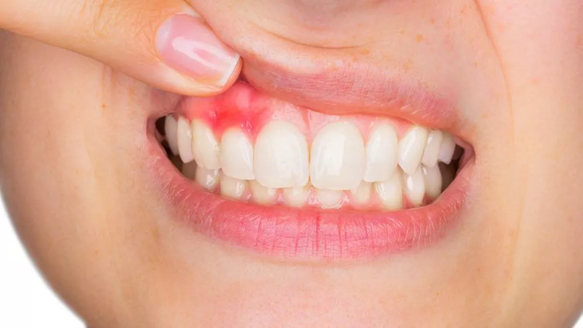Durerea de dinți îmbrăcați. Din ce cauze apare acest disconfort și ce tratament îl poate calma?