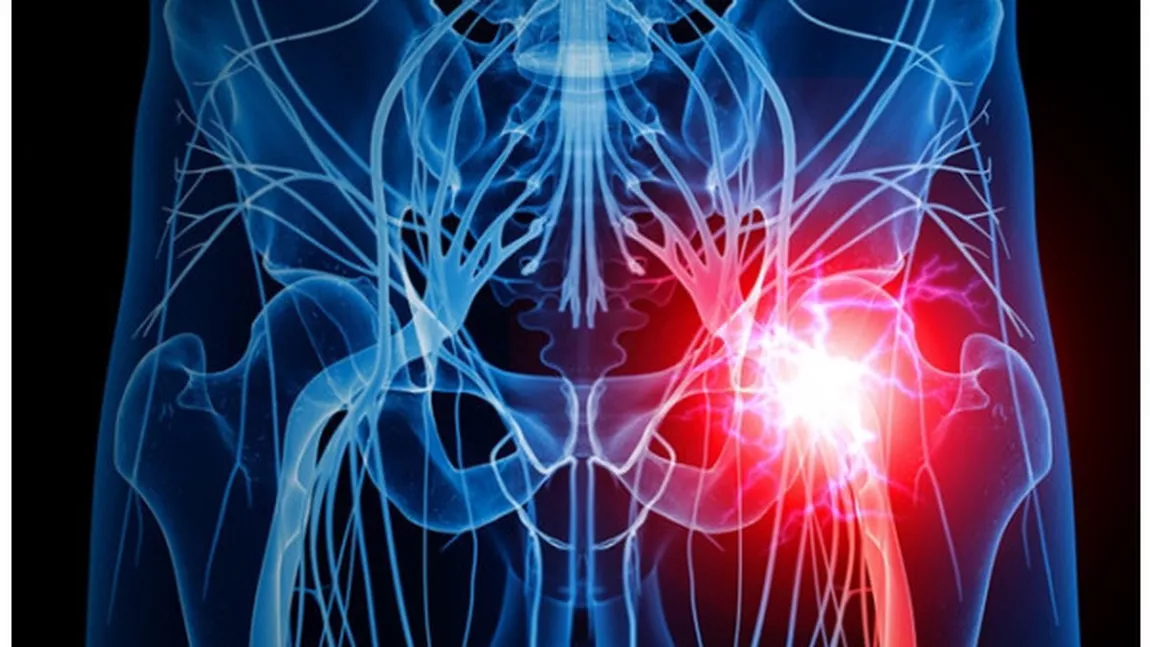 Ce este coxartroza (artroza șoldului)? Cauze, simptome și metode de diagnostic