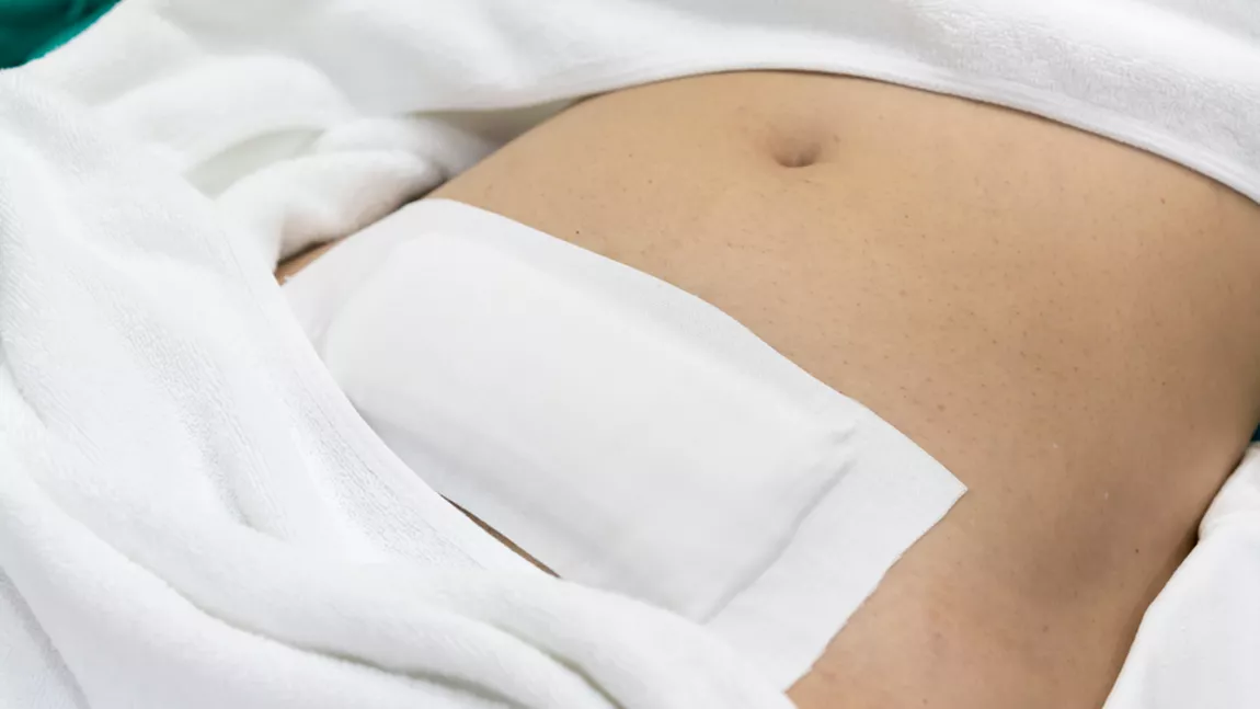 Cât durează operația de fibrom uterin? Factorii care influențează durata intervenției chirurgicale