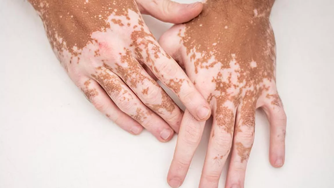 Leacuri bătrânești pentru vitiligo, tratarea dar și cauzele acestei afecțiuni